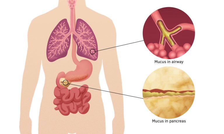 Cystic Fibrosis: A Growing Concern Over This Hereditary Condition Which Mostly Affects the Digestive System