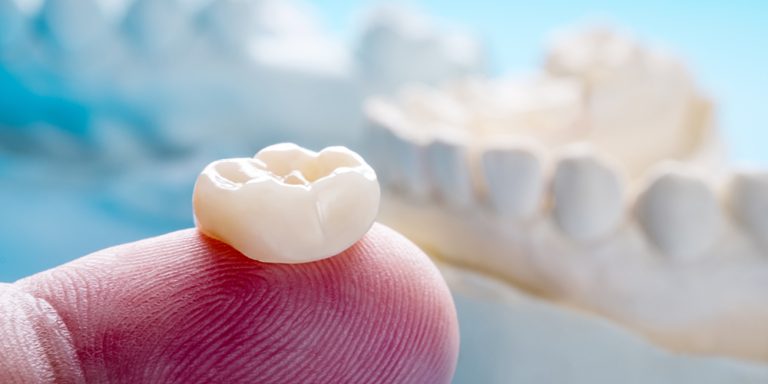 All You Need to Know About Dental Crowns in Fort Lauderdale