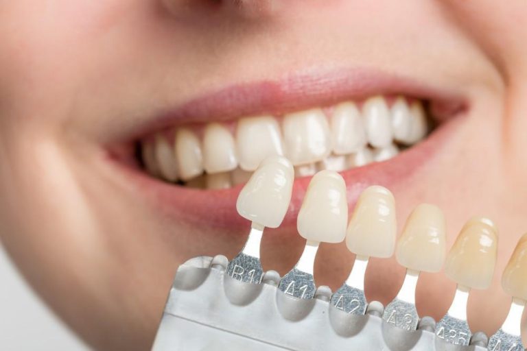 What Dental Problems Can Veneers Fix?