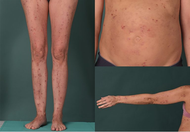 Pruritus Therapeutics Demand Is Growing with Increasing Prevalence of Dermatological Disorders and Requirement for Proper Diagnostics and Therapeutics
