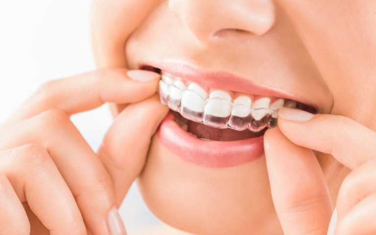 Tips and Tricks for Invisalign Treatment