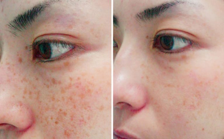 How Is Skin Pigmentation Treated?