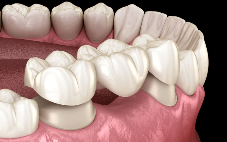 Dental Crowns And Bridges: Restoring Function And Aesthetics