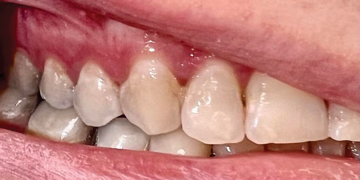 2 Essential Indicators Of Early Enamel Demineralization